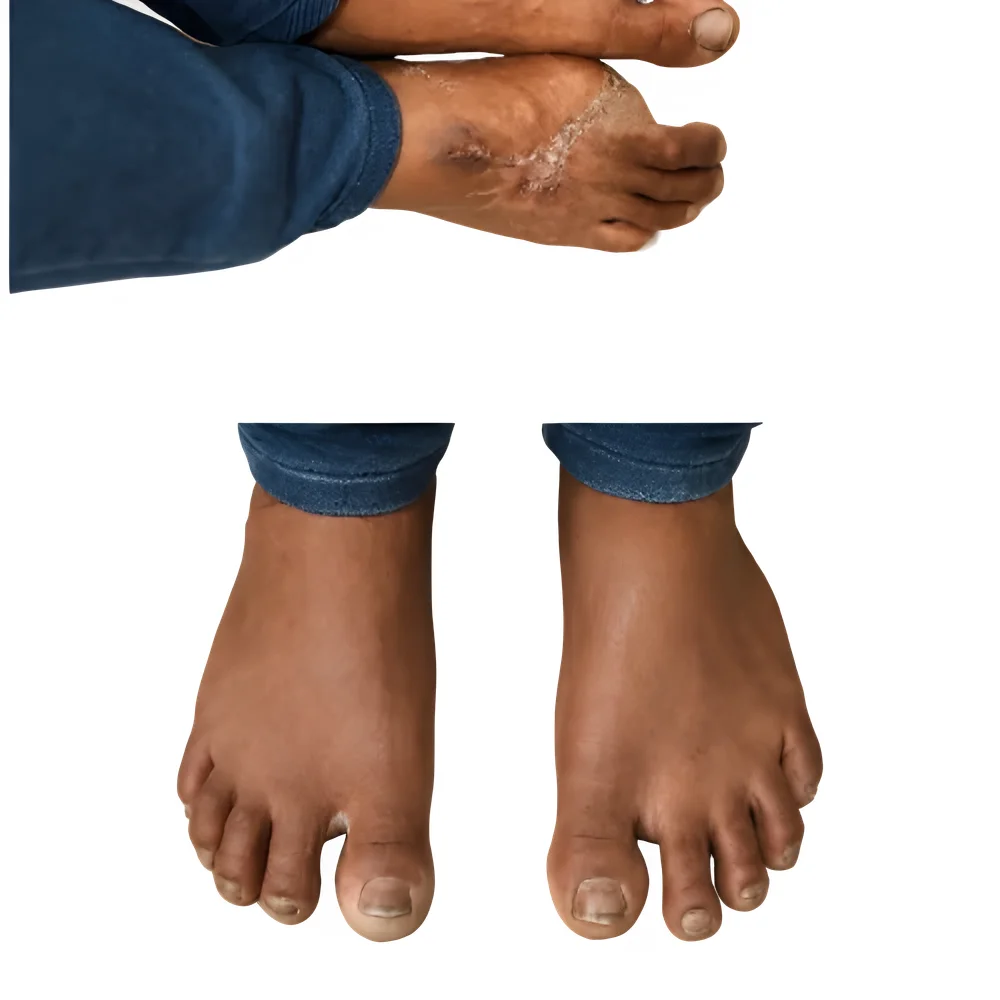 Silicone Foot Prosthesis - Healthcare & Medical by Bhat Shawl Collection